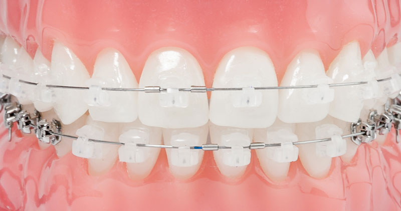 Why you should think of opting for invisible braces?