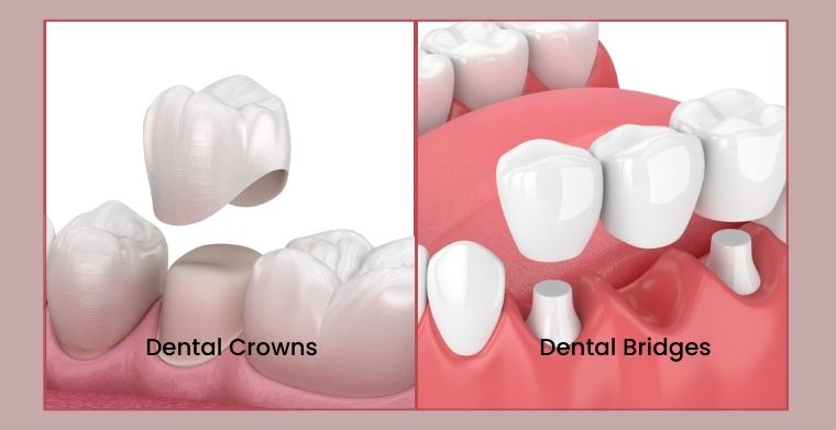 Dental Crowns and Bridges