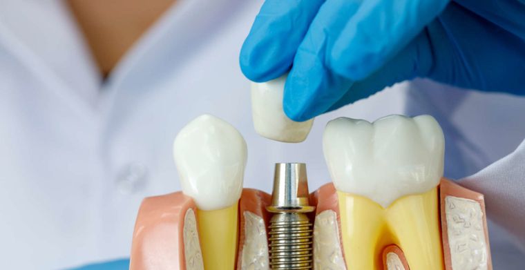 Dental Implants