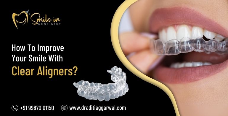 Clear Aligners