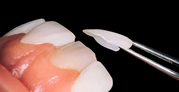 Cosmetic Dental Treatment