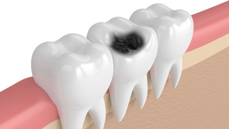 causes of tooth decay