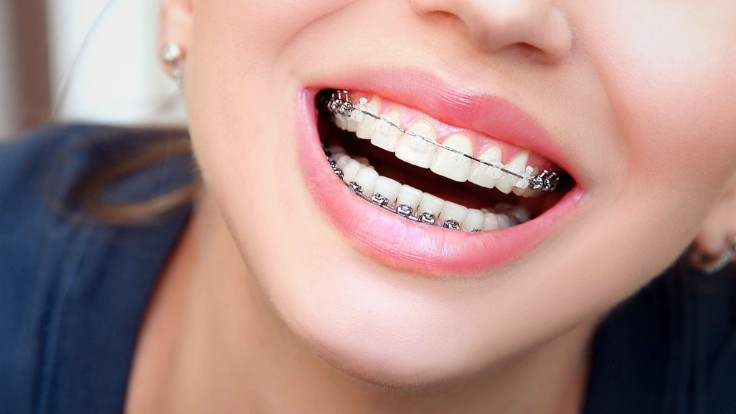invisalign braces